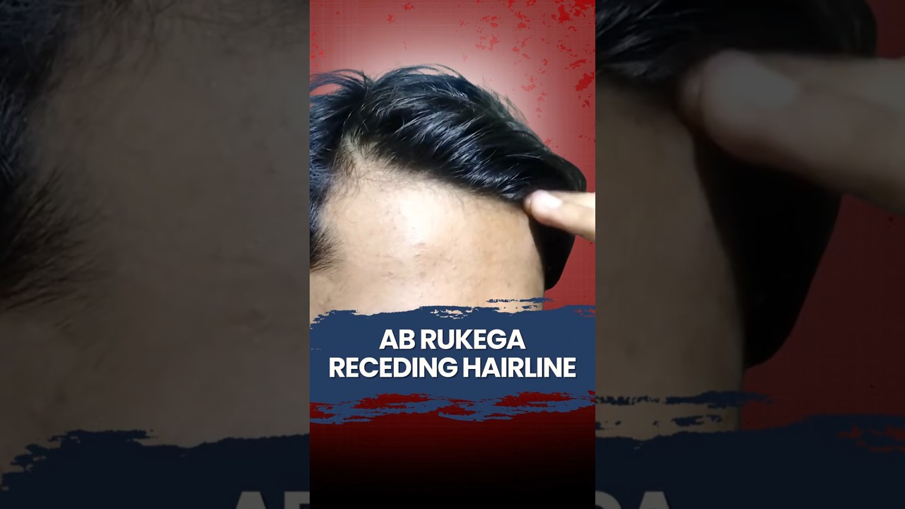 Stop receding hair line and regrow | Hair loss | Hair fall | Teenage Hair loss | WaidonAI 