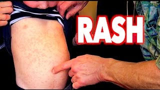 GREAT LOOKING RASH! (Full Body) | Dr. Paul