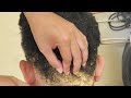 Big Flake In My Mother Hair !! Many Dandruff Scratching Scalp 2