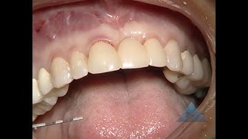 Demo C2-2 Soft Tissue Ridge Augmentation with Esthetic Crown Lengthening