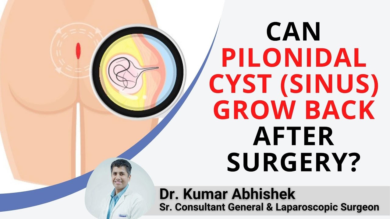 Pilonidal Sinus Disease (Pilonidal Cyst) - Dermatology Advisor