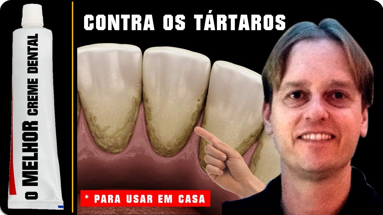 [Tártaro No Dente] - O MELHOR Creme Dental Contra Tártaro no Dente que ...