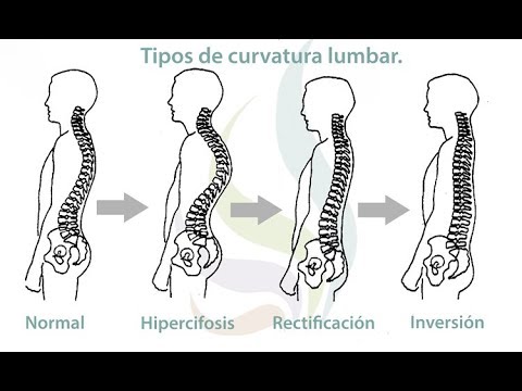 Que es la Lordosis e Hiperlordosis- HogarTv por Juan Gonzalo Angel