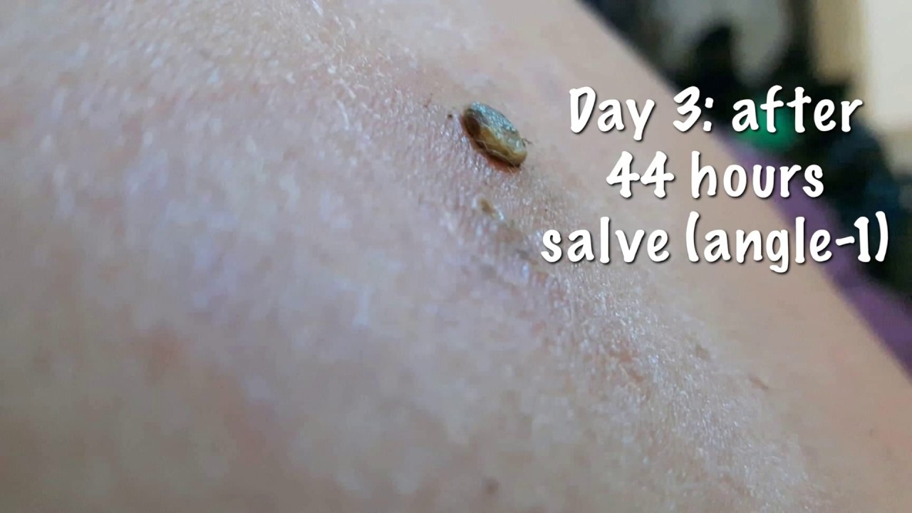 18 Day Black Salve Mole Removal You 18 Day Black Salve Mole Removal