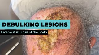 Dermatologist Debulks Lesions Caused By Erosive Pustulosis Of The Scalp | CONTOUR DERMATOLOGY