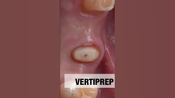 Vertiprep crown #dentistry #restorativedentistry #prosthodontic #dentalcrowns #endodontic
