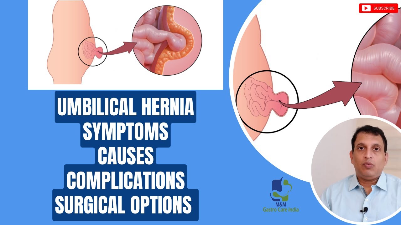 Inguinal Hernia Repair by Dr. David W. Ford