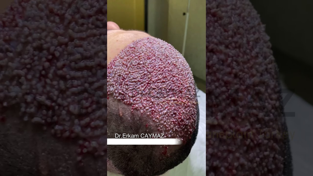 High Density Hair Transplantation