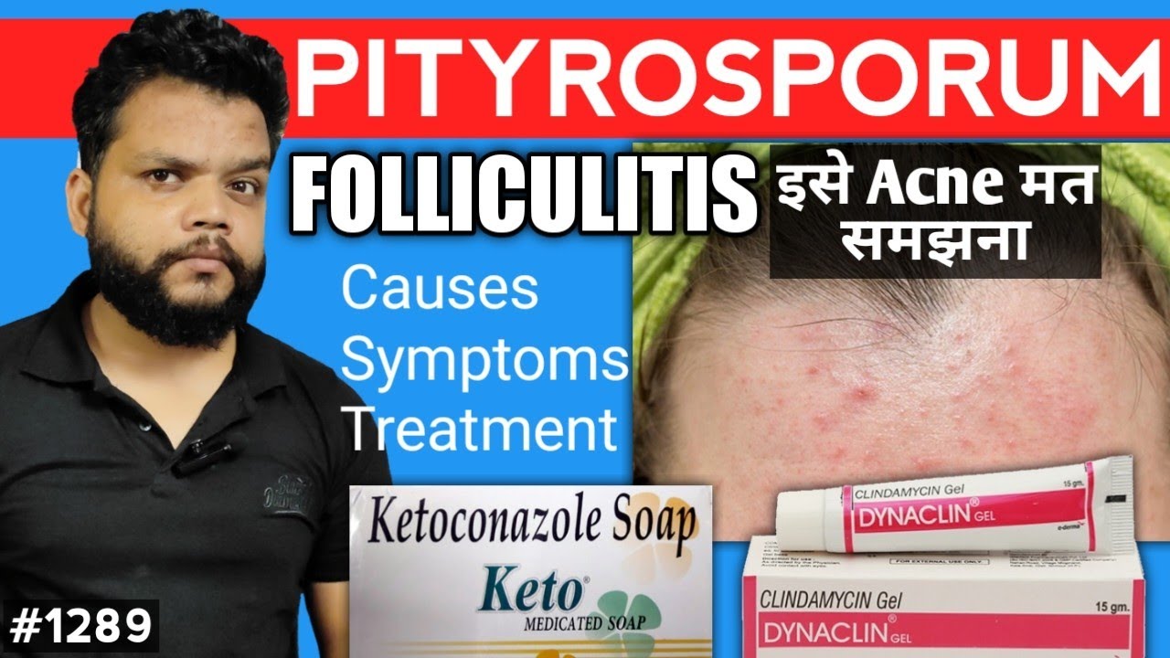 Fungal Acne का कारण और इलाज Pityrosporum Folliculitis Causesymptoms