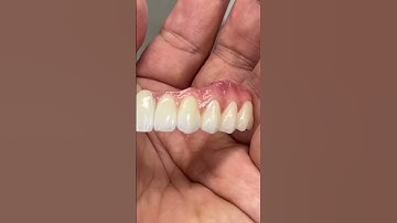All-On-4 Zirconia