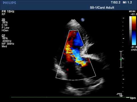 Videó: Aorta Szűkület - Tünetek, Fokok, Kezelés