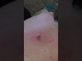 Popping a 10 year old cyst! Boy was that fun! **** 18+ only. Strong language.*