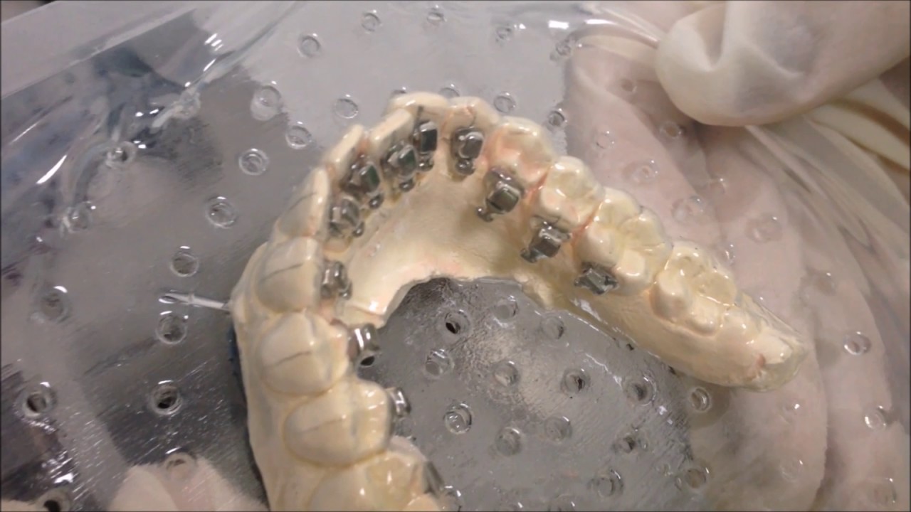 Técnica de cementado indirecto brackets linguales