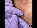 Under Eye Filler