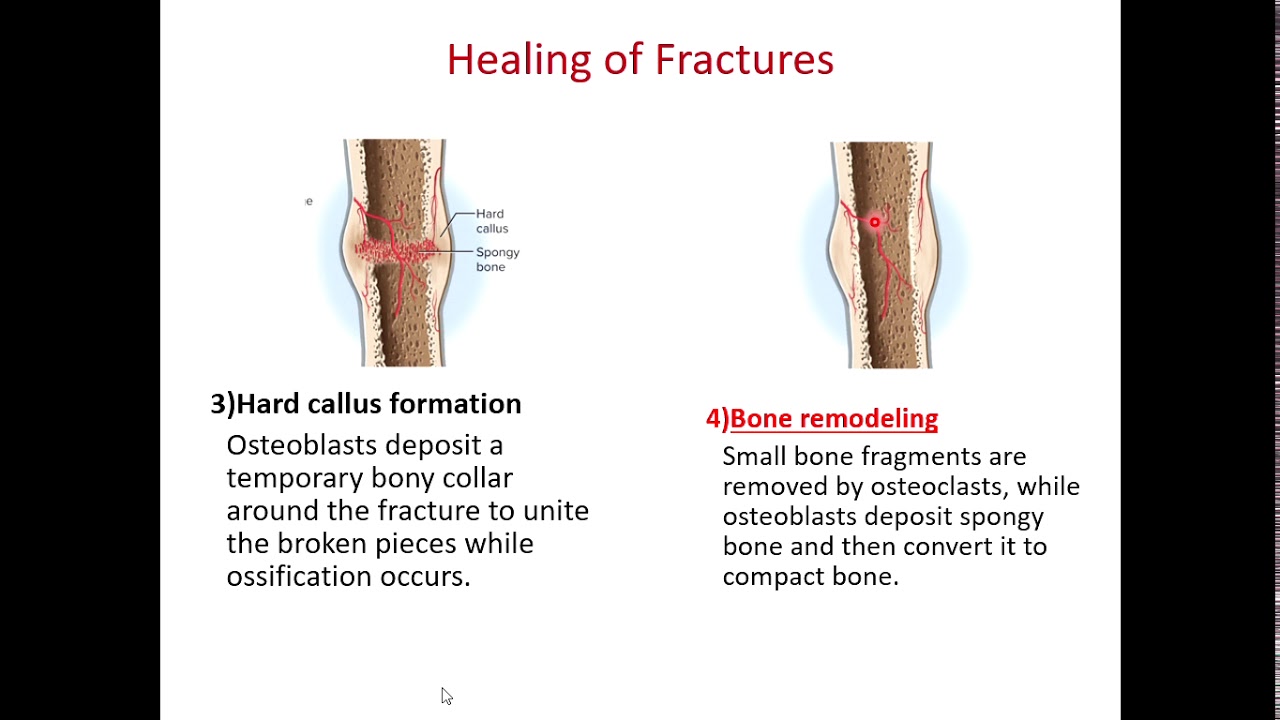 BIOL 214 Bone Fractures and Disease (Ch 7 Part 6) - YouTube