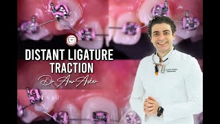 Orthodontic Canines traction by distant ligature method  by dr Amr Asker
