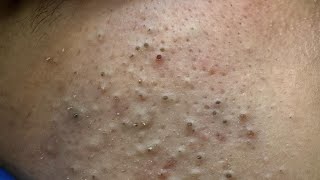 Deep Pore Cleansing Forehead | Acne & Pimple Treatment | Blackhead Removal | Remove Blackheads