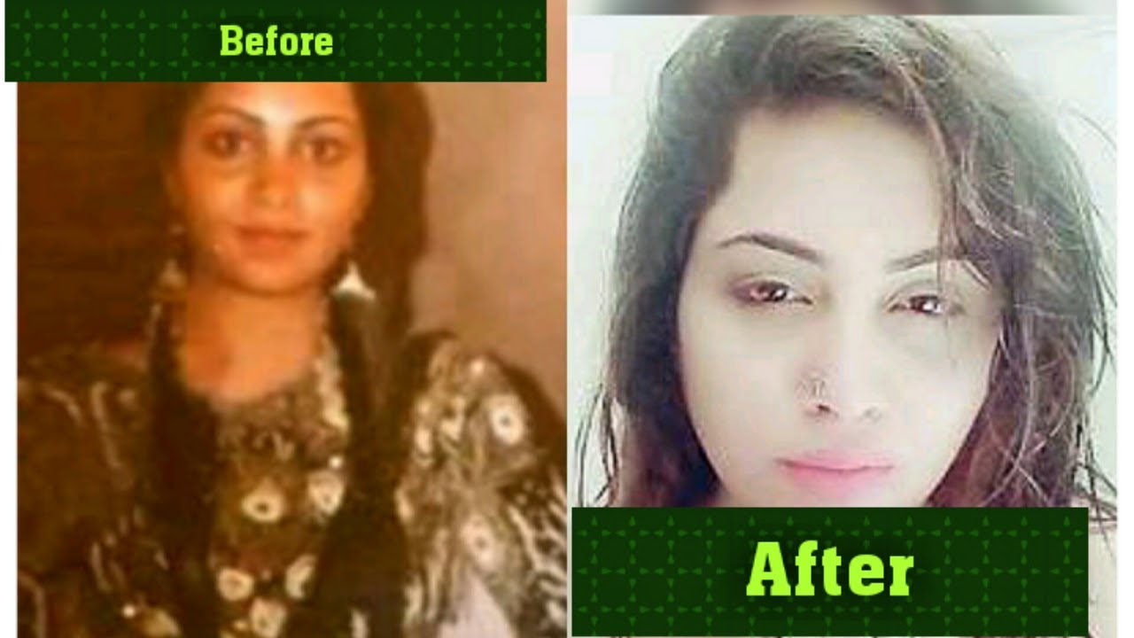 top 5 plastic surgery of popular tv actresses BEFORE & AFTER
