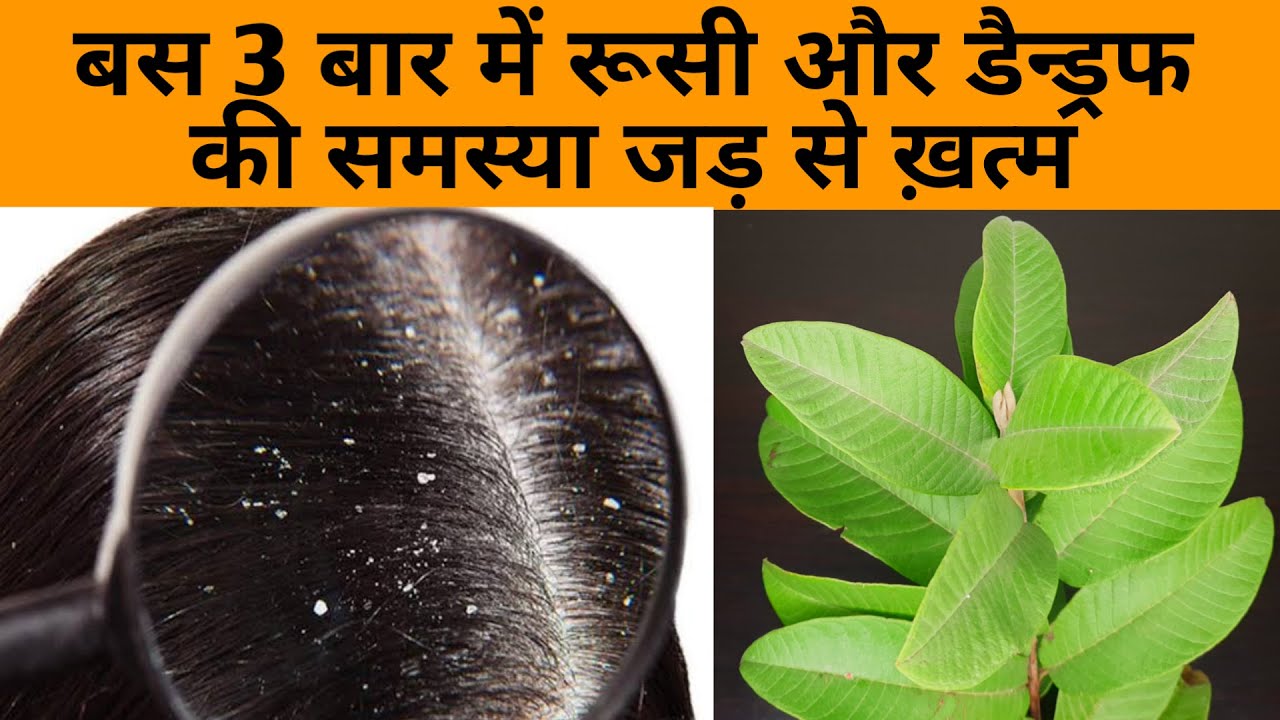 बस 3 बार लगाएं, रूसी डैंड्रफ की समस्या जड़ से ख़त्म,बालों की लम्बाई इतनी बढ़ेगी खुद ही देखकर चौंक जाओगे