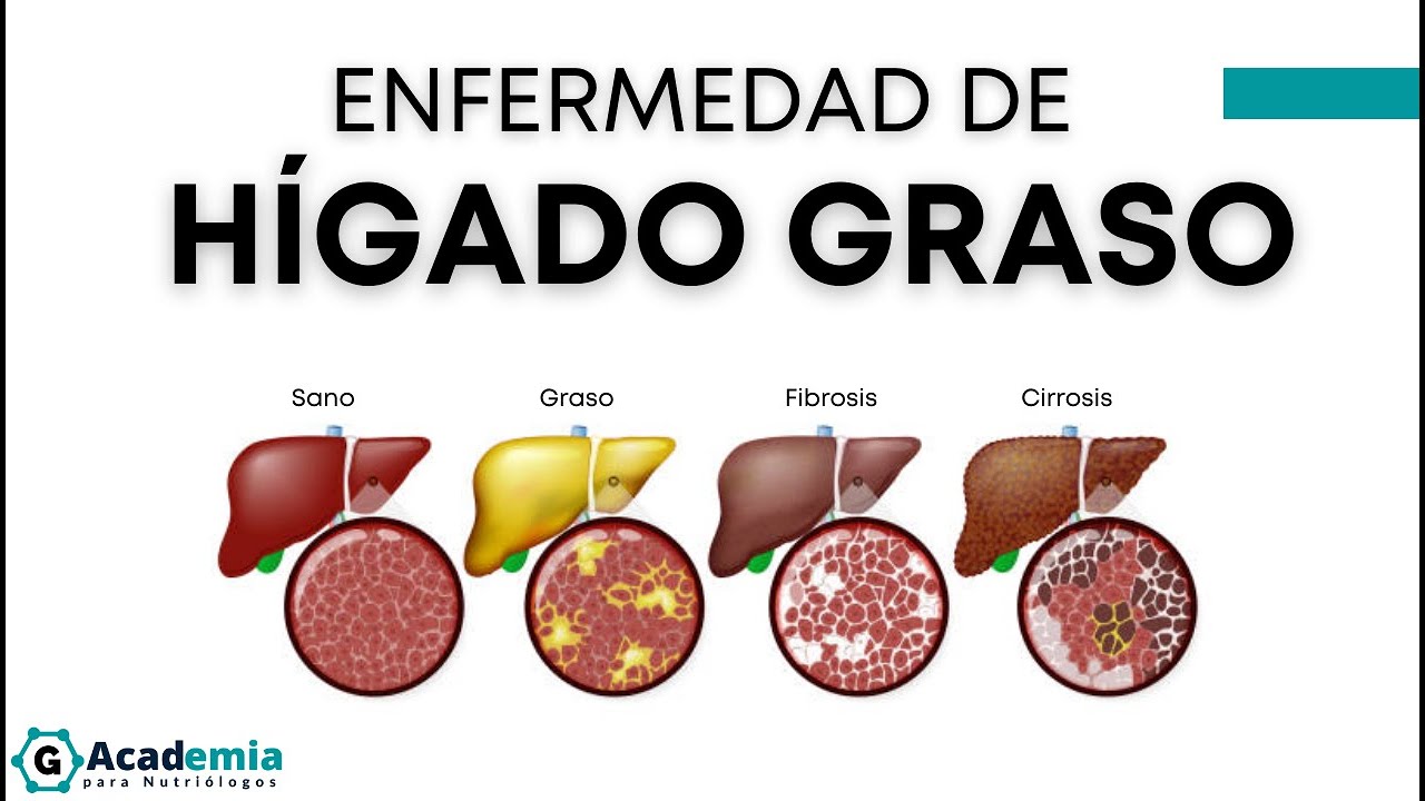 ¿Qué es el hígado graso | Esteatosis hepática