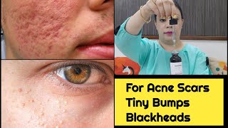 Face Serum For Oily Skin|Acne Scars|Blackheads |Minimalist 2% Salicylic Face Serum  Review