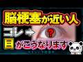 【要注意】絶対知っておいてほしい!脳梗塞が近い人だけに起こる「目の異変」について解説(脳梗塞 危険なサイン)
