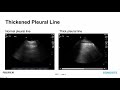 Webinar Lung Ultrasound For COVID 19