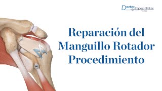 Reparación del manguillo rotador procedimiento - Doctores Especialistas Mexico