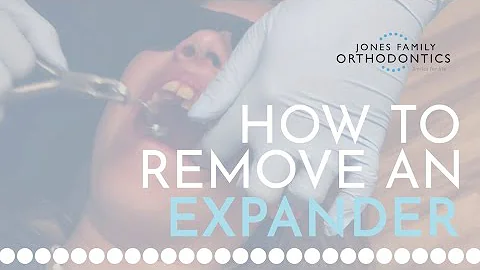 Expander Removal Process | Jones Family Orthodontics | Monroe, WA