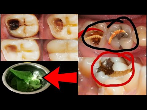 2 నిముషాల్లో మీ పిప్పి పన్ను లో ఉన్న పురుగులు మాయం చేసే అద్భుతమైన చిట్క | teeth home remedy