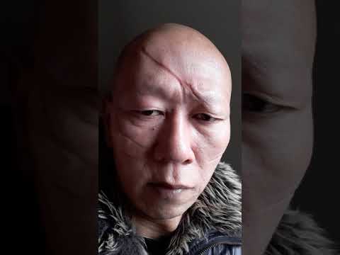 顔の傷 刃物傷 刀傷 Youtube 顔の傷 刃物傷 刀傷 Youtube