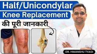 Half (Unicondylar)  Knee Replacement की पूरी जानकारी | Half Knee Replacement Surgery Explained