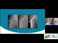 OrthoTV Original Fixation Failures in IT Fractures   Dr Satish Mutha
