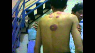 hasil bekam masuk angin.mp4