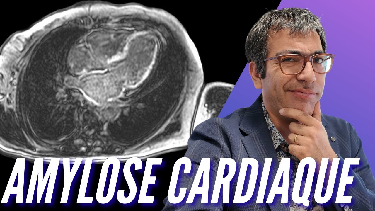 Amylose cardiaque : le rôle clé de l'IRM