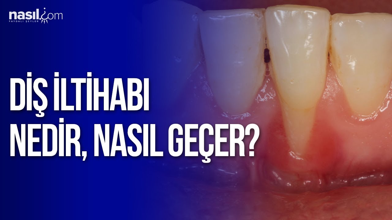 dis iltihabi nedir nasil gecer saglik nasil com youtube