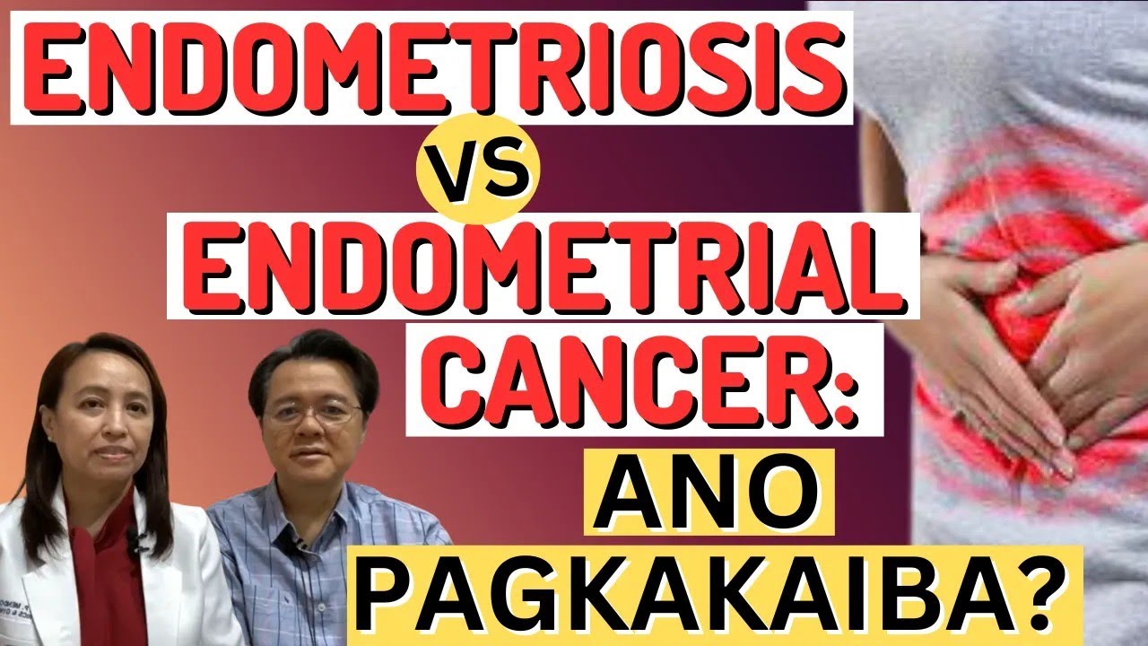 Endometriosis vs Endometrial can-cer : Ano Pagkakaiba? - By Doc Willie Ong and Doc Sharon Mendoza