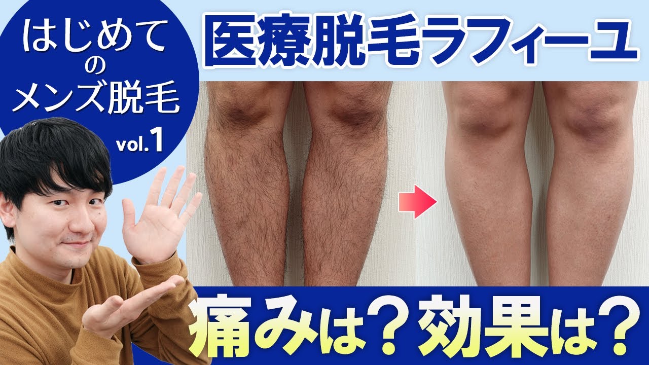 施術モニター体験レポ 医療脱毛の様子と経過をお見せします メンズ医療脱毛 Youtube