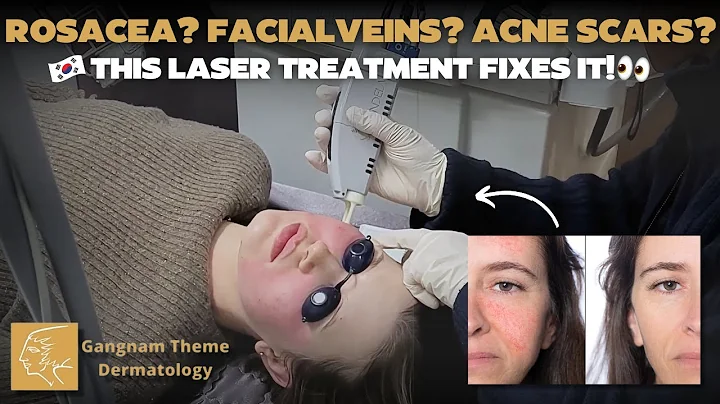 The V-Beam Laser (Vascular Laser)– The Skin Redness Solution! 🔴✨