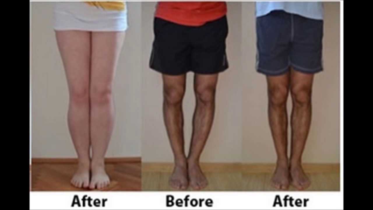 Bow Legs No More review - Discount [Don't Buy Before Watch Video]