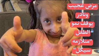 عمرها 11 عاماً ووزنها 5 كيلوغرامات - حكاية أصغر طفله مصرية في العالم مصابه بمتلازمة 