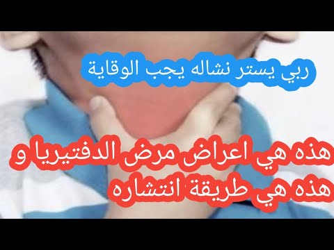 هذه هي اعراض مرض الدفتيريا و هذه هي طريقة انتشاره بين الأشخاص الحذر مطلوب