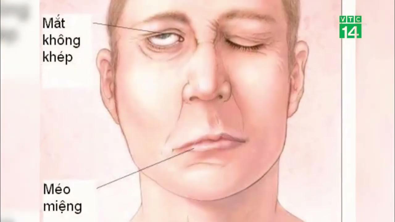 Периферический парез лицевого нерва симптомы. Прозопарез что это такое. Прозопарез что это такое. Центральный и периферический паралич лицевого нерва. Периферический парез лицевого нерва симптомы.