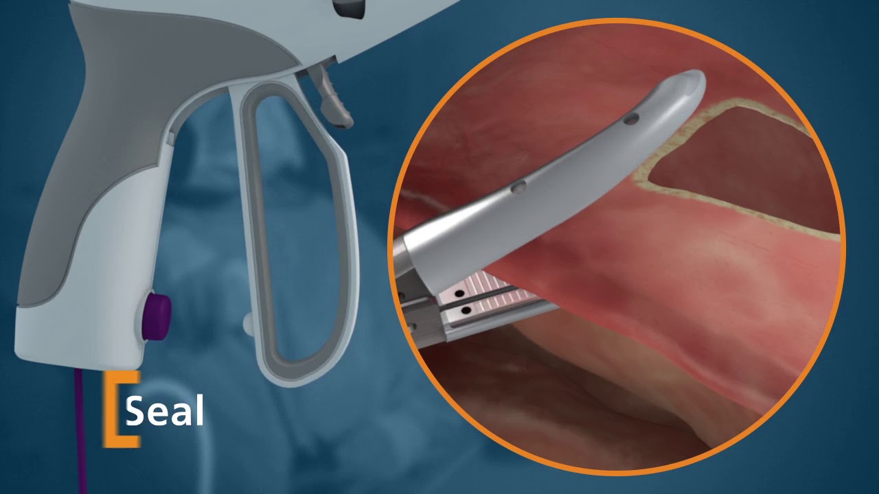 EU 13 0481 74 Ligasure Maryland jaw animation US140616a