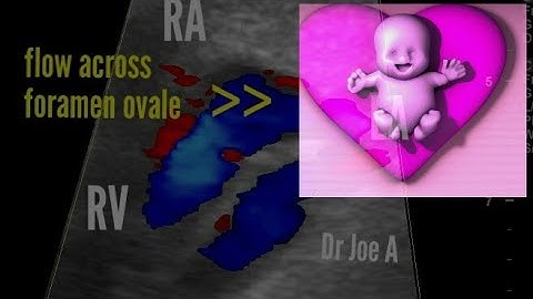 Normal fetal echo showing 4 chamber view, foramen ovale, 3 vessel view,  ultrasound, color Doppler