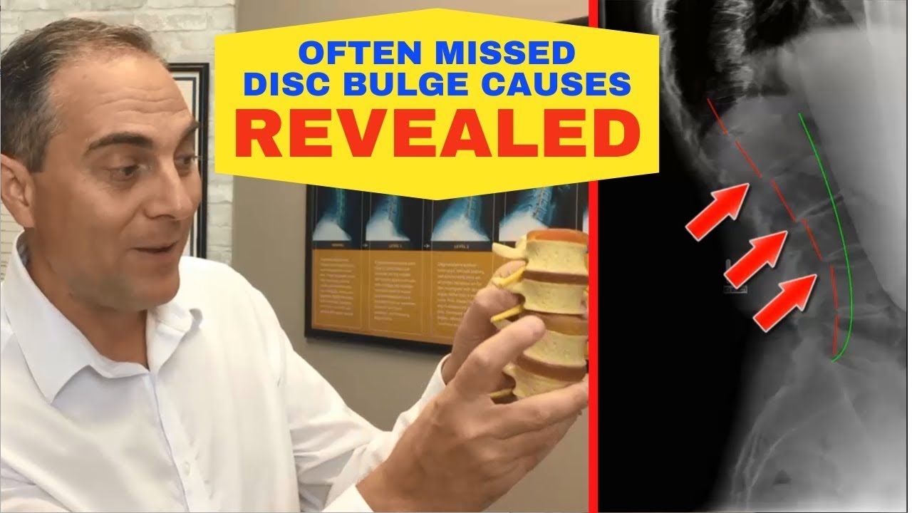 Most Disc Bulge Patients Have No Idea - 3 Often Missed Causes of Lumbar Disc Bulge - L4-L5, L5-S1