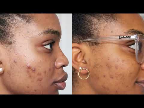 Cystic Acne! Visit WorldsGreatestMedical.com