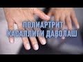 Полиартрит касаллиги даволаш | Полиартрит лечение #полиартрит #лечение #qonbosimi