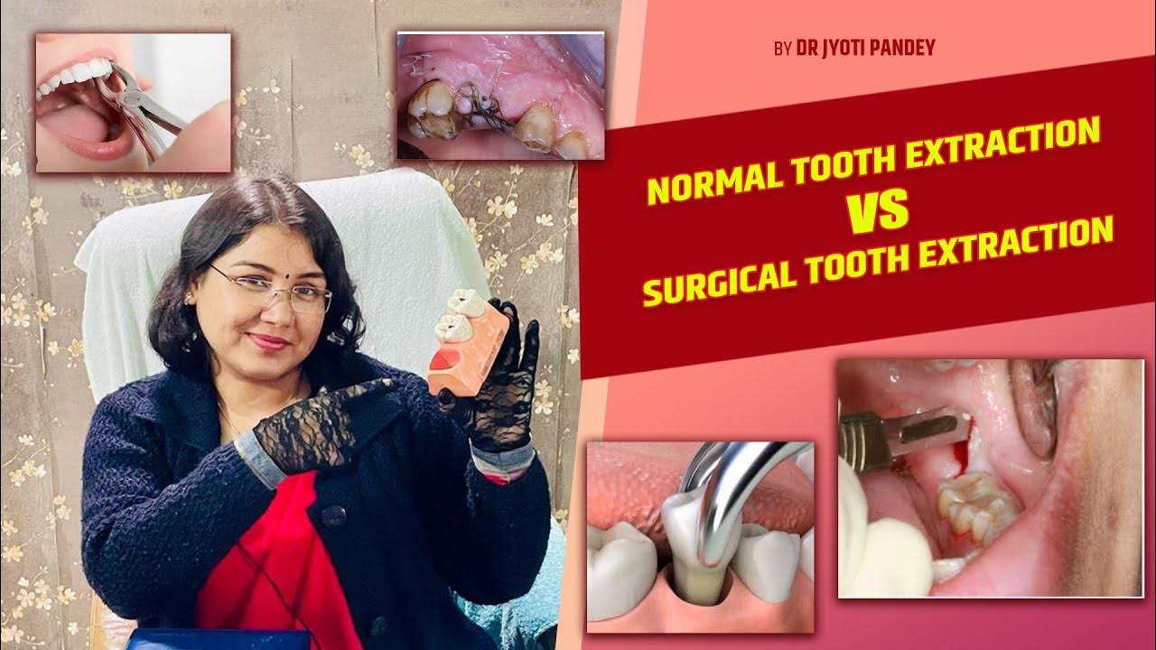 Normal tooth Extraction VS surgical tooth Extraction… YouTube