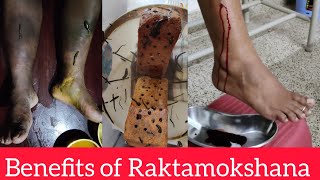 Benefits of Raktamokshana or Blood Letting Ayurveda Panchakarma Treatments..